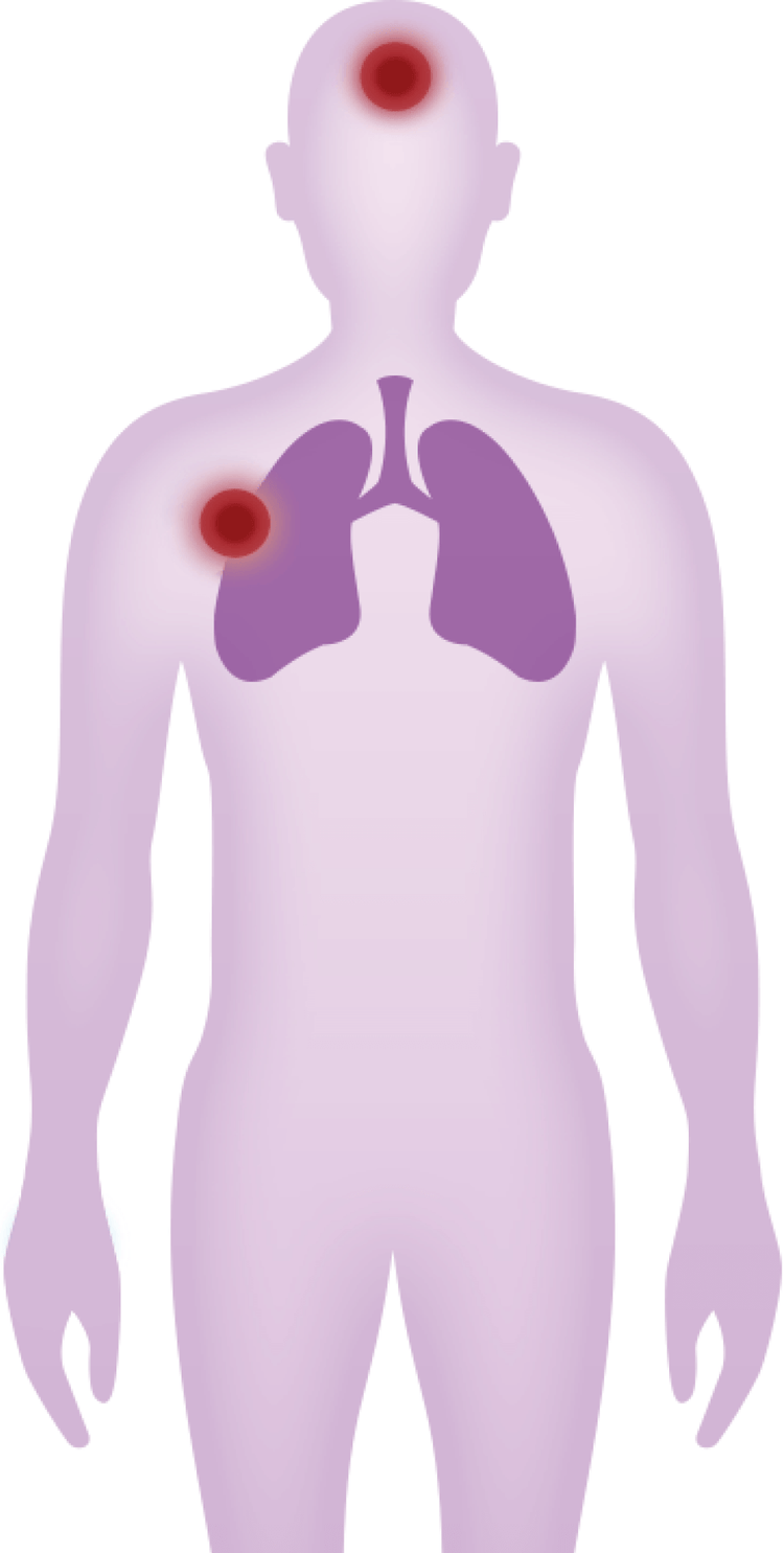 The symptoms, consequences and complications of pneumonia